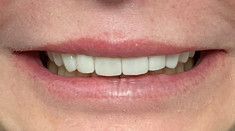 Lisa After