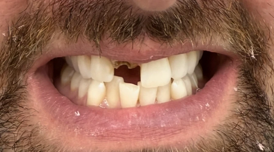 lux_dental SG Before