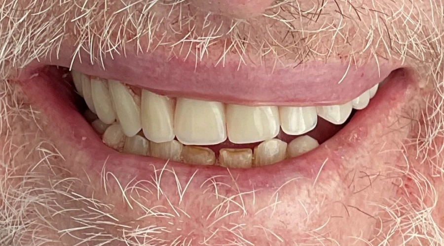 patient 1 after