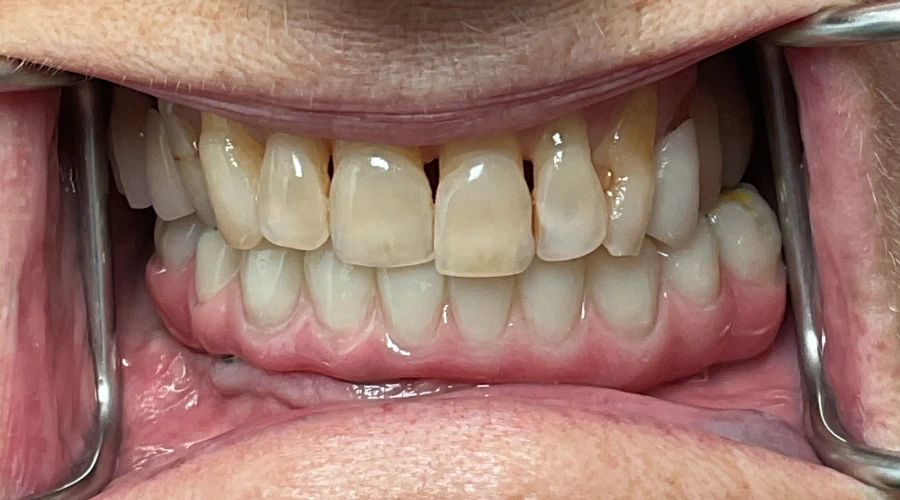patient 3 after